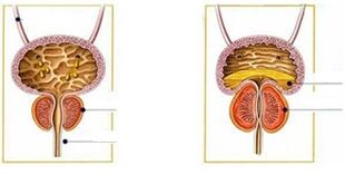 The type and form of prostatitis in men