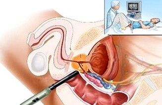 Way to diagnose prostatitis
