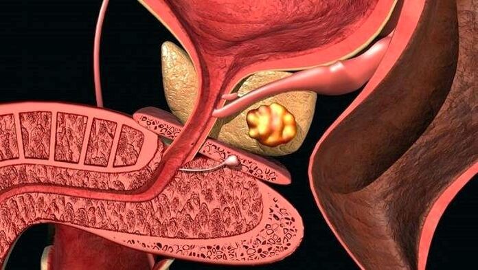 Stone deposits in the prostate with calculous prostatitis