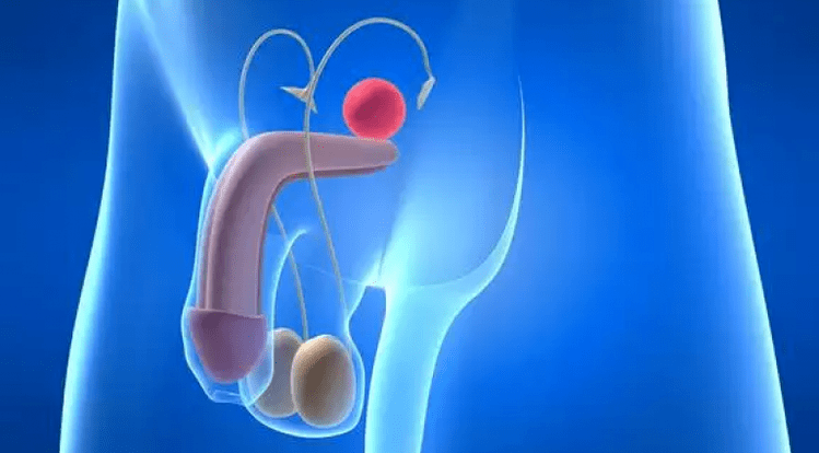 Prostatitis is inflammation of the prostate gland in men, requiring complex treatment
